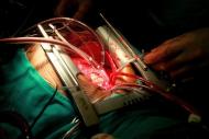 Cirurgião faz operação de coração em Cartum, Sudão, 20 de fevreiro de 2013