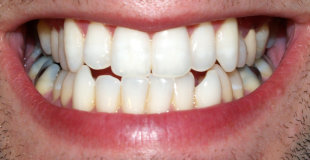 全台各縣市植牙收費項目混亂，一顆牙有的要4萬元，有的要15萬元。（photo by wikimedia）