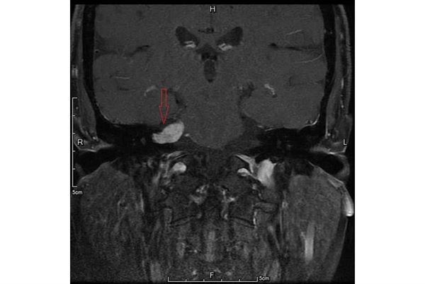 核磁共振檢查發現婦人的右內聽道處出現1.7公分聽神經瘤（紅色箭頭處）。（圖片提供／台大醫院新竹分院）