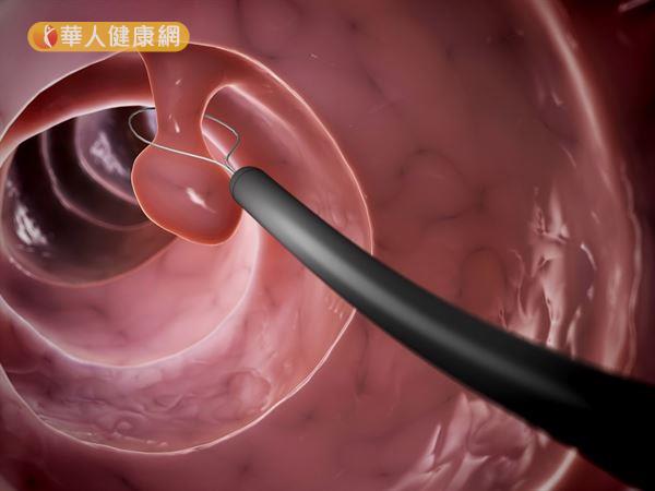 大腸瘜肉是指腸腔內黏膜表面出現的隆起病變。圖僅為大腸瘜肉示意圖。