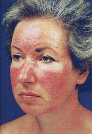 酒糟鼻是種常見的皮膚疾病，通常會有小小的紅色丘疹，遍佈在臉頰兩側和鼻子上。（photo by affordablelaser）