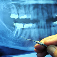 美國研究透過動物實驗發現，藉由抑制免疫反應中的補體系統，可減輕牙齦發炎反應，避免牙齒因牙床骨質流失而鬆脫。（photo by Wonderlane on Flickr- used under Creative Commons license）