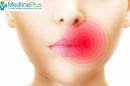 Έρπης στο στόμα: Αίτια και πρώιμα συμπτώματα