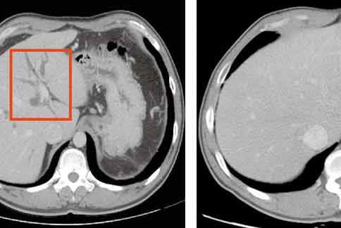 從影像判讀，（左圖）為假性腫瘤，治療後，腫瘤消失（右圖）。（圖片提供／台北慈濟醫院）