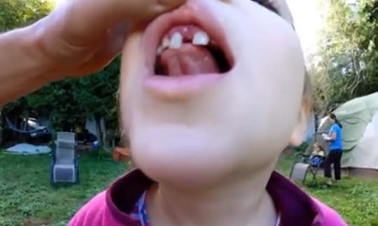 This Father Pulled Out His Daughter’s Wobbly Tooth With A Drone